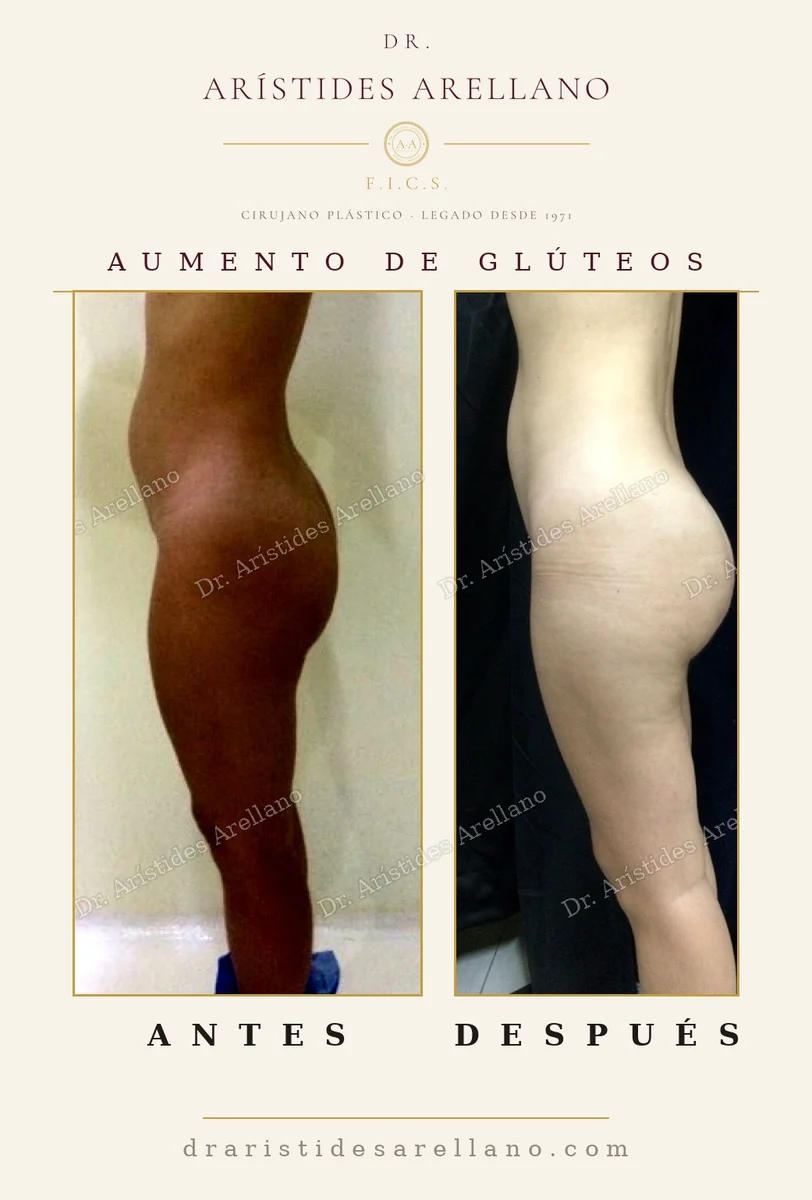 Aumento de glúteos BBL antes y después en vista de perfil, proyección lograda con grasa propia, caso real del Dr. Arístides Arellano, cirujano plástico en Puebla