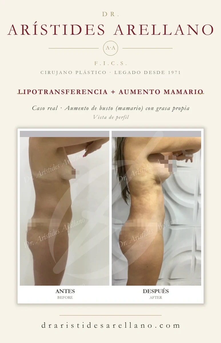 Aumento de busto (mamario) con grasa propia por lipotransferencia — antes y después de perfil, caso real del Dr. Arístides Arellano en Puebla