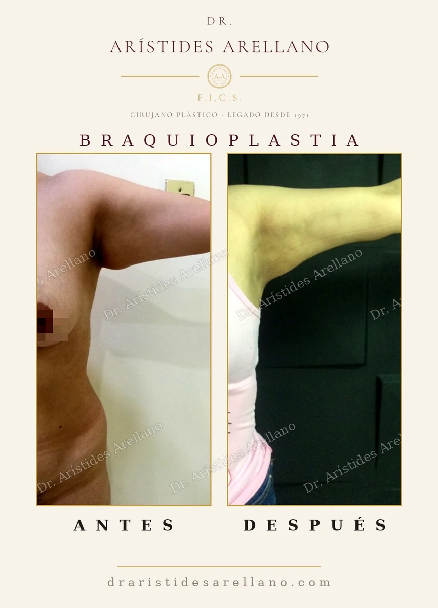 Braquioplastia antes y después, retiro de piel sobrante en el brazo tras pérdida de peso, cirugía del Dr. Arístides Arellano, cirujano plástico en Puebla