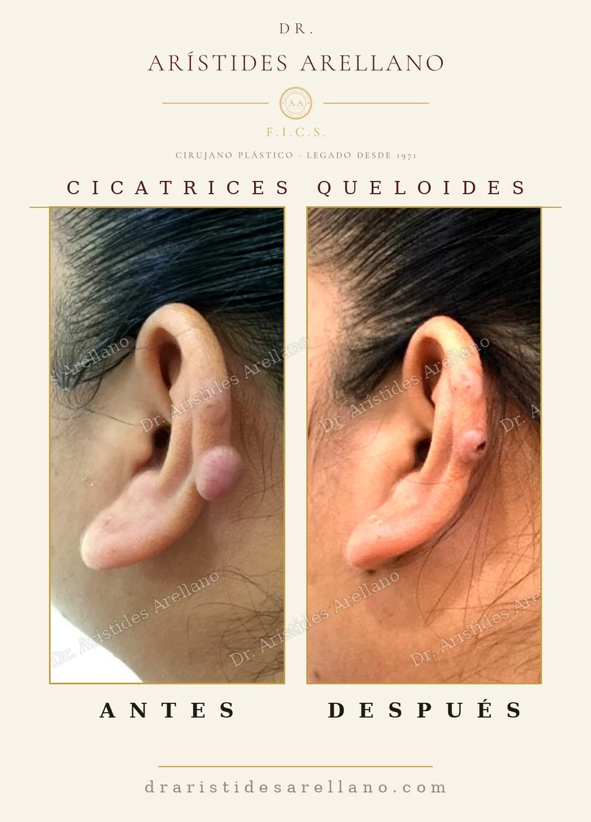 Queloide en el lóbulo de la oreja antes y después de la extirpación, cicatriz queloide por perforación, cirugía del Dr. Arístides Arellano, cirujano plástico en Puebla
