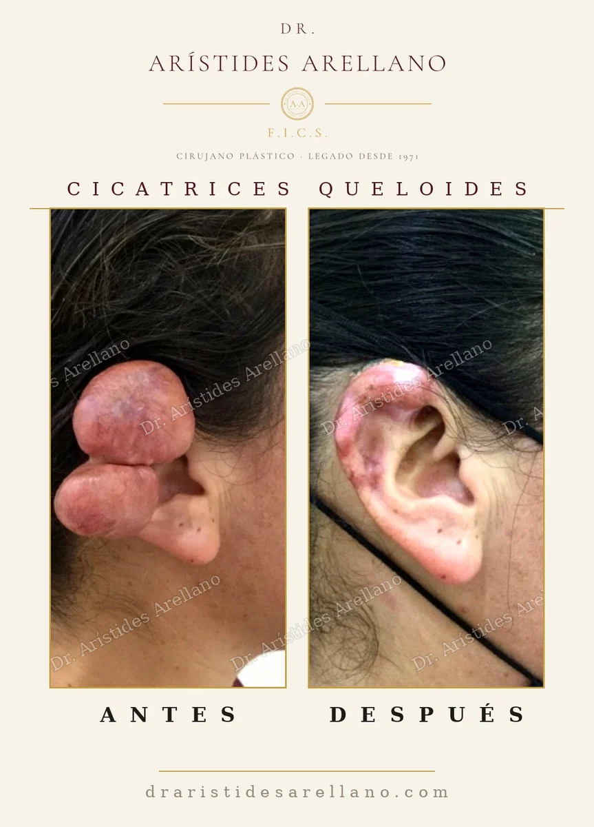 Extirpación de queloide grande en la oreja antes y después, reconstrucción del lóbulo, resultado real del Dr. Arístides Arellano en Puebla