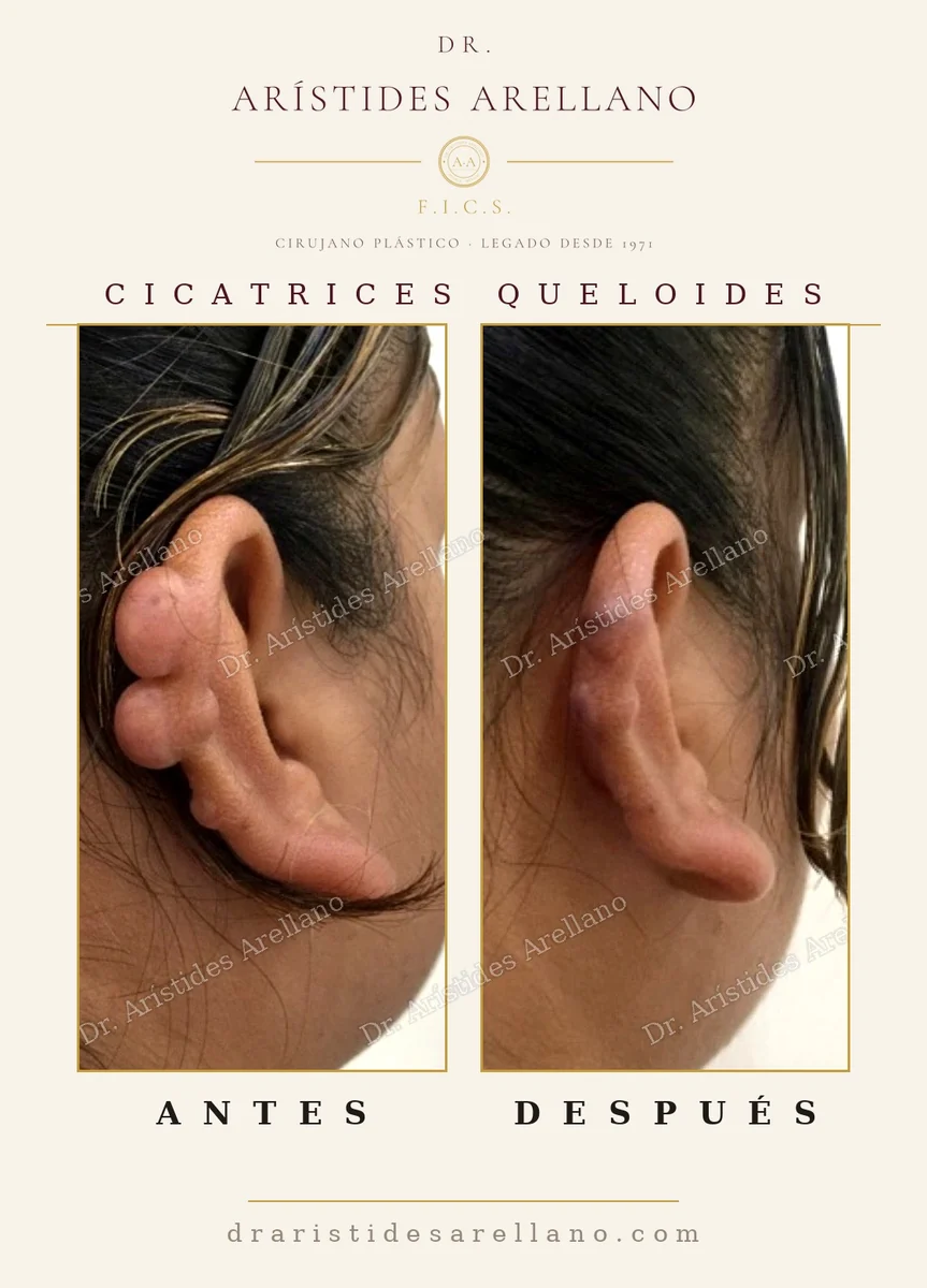 Queloides múltiples en la oreja antes y después, corrección quirúrgica y seguimiento, caso del Dr. Arístides Arellano, cirujano plástico en Puebla