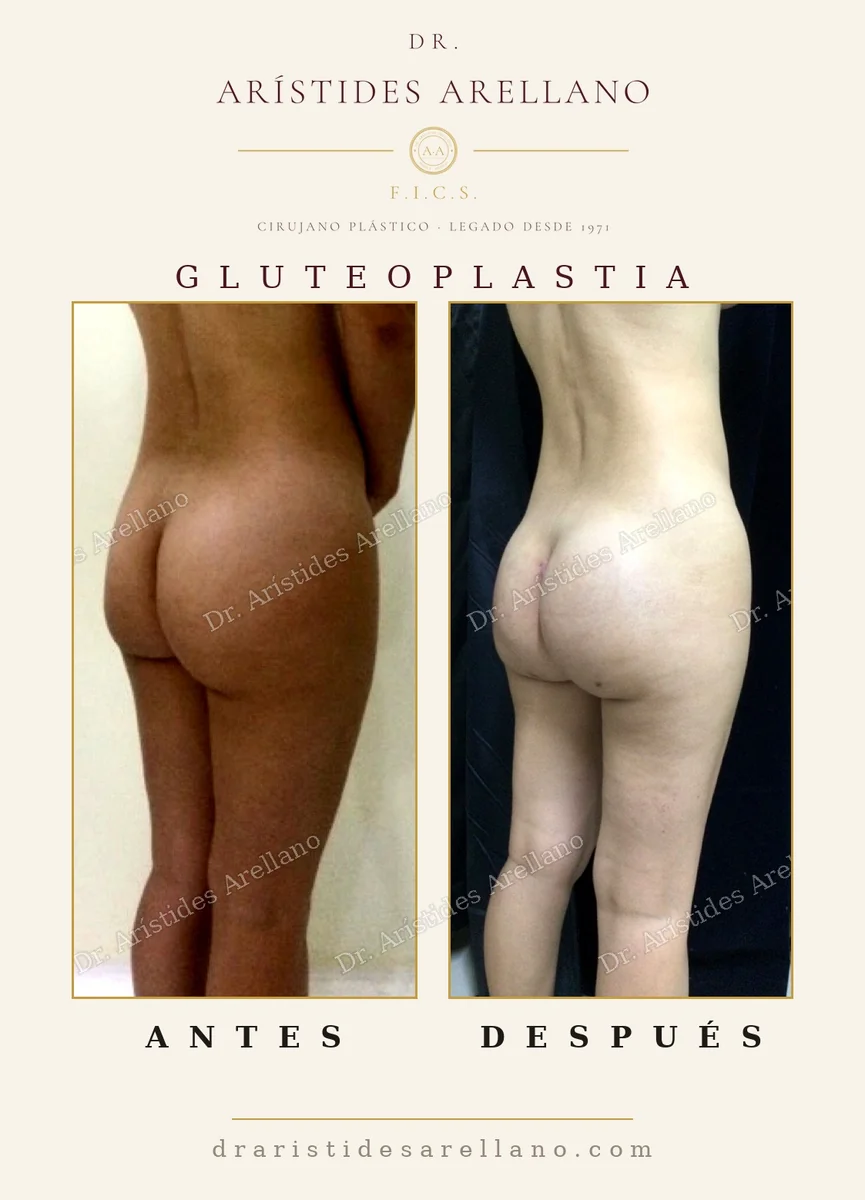 Aumento de glúteos con implante antes y después en vista posterior, resultado en paciente delgada sin grasa donante, caso del Dr. Arístides Arellano, cirujano plástico en Puebla