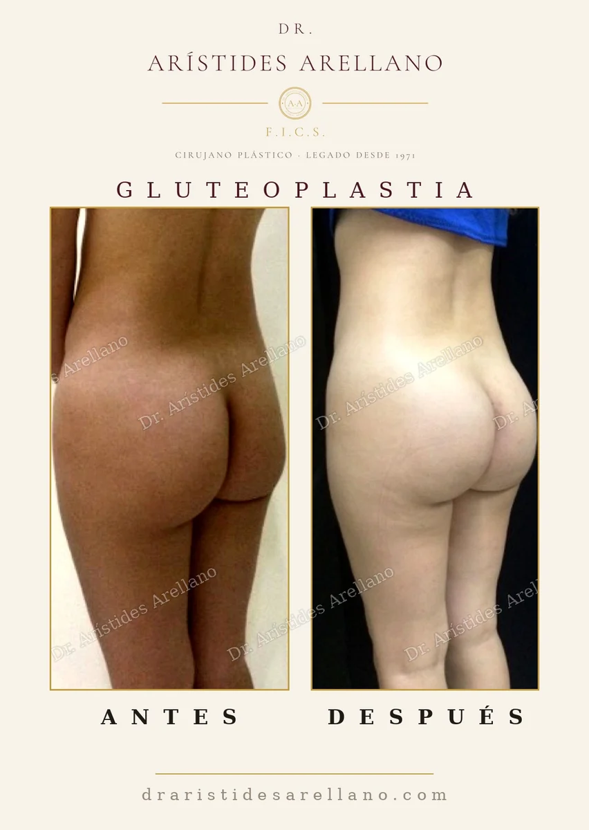 Gluteoplastia antes y después, colocación intramuscular del implante y cicatriz oculta en el pliegue interglúteo, resultado del Dr. Arístides Arellano en Puebla