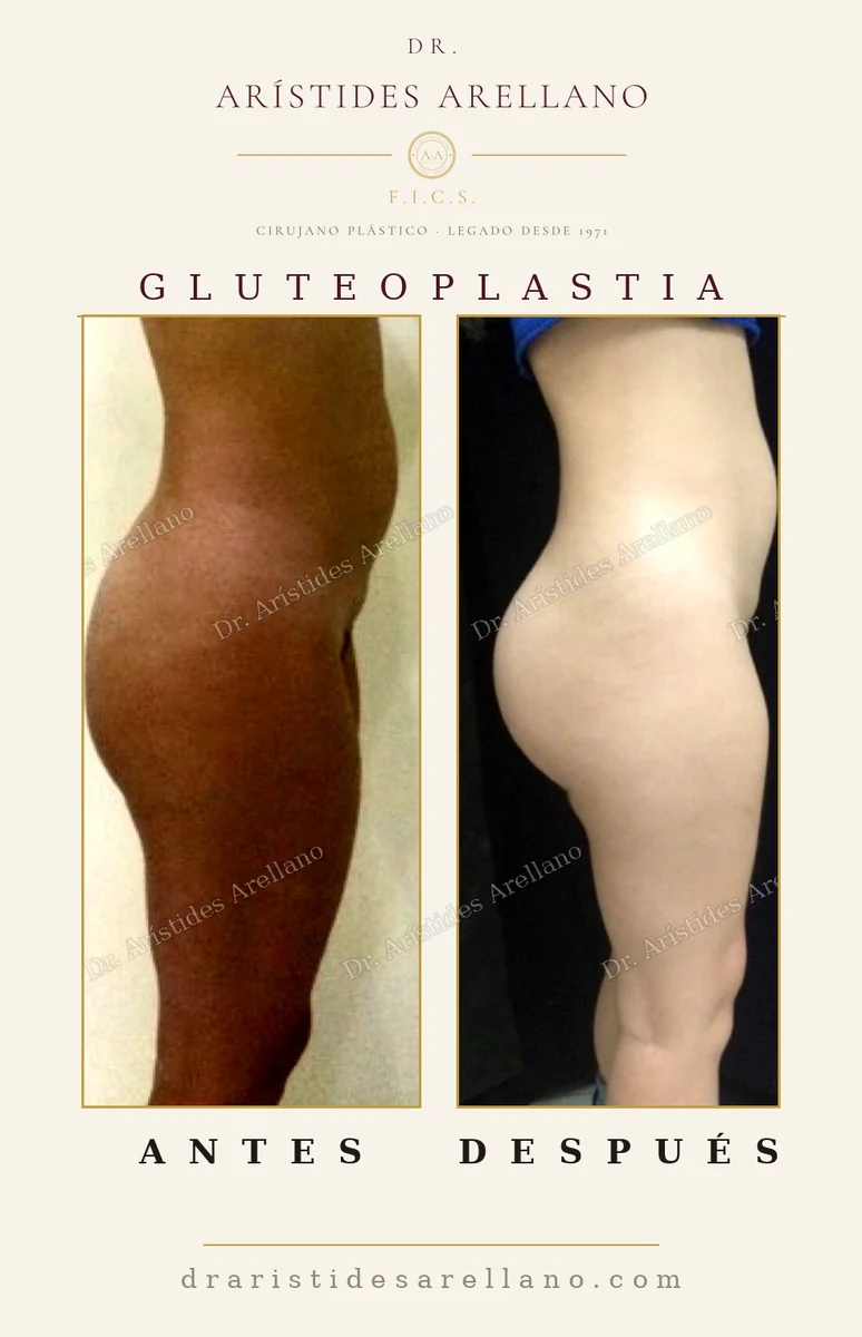 Gluteoplastia antes y después en vista de perfil, evolución de la recuperación tras el implante glúteo, caso real del Dr. Arístides Arellano en Puebla
