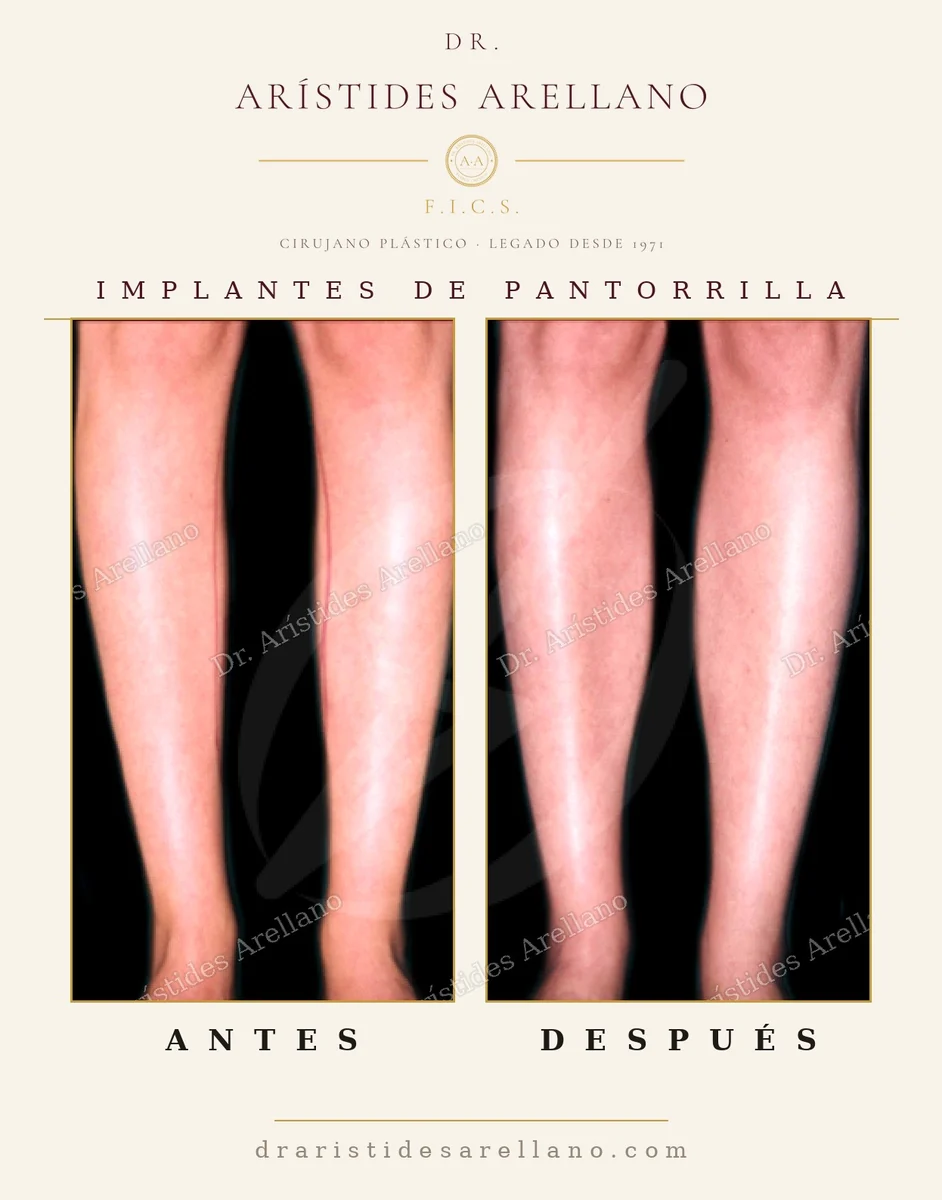 Implante de pantorrilla antes y después, aumento del volumen de la pierna con implante de silicón sólido, cirugía del Dr. Arístides Arellano en Puebla
