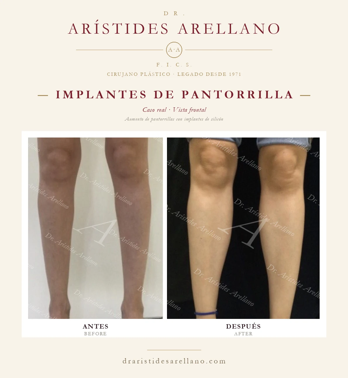 Implantes de pantorrilla — antes y después en vista frontal, aumento de pantorrillas con implantes de silicón, caso real del Dr. Arístides Arellano en Puebla