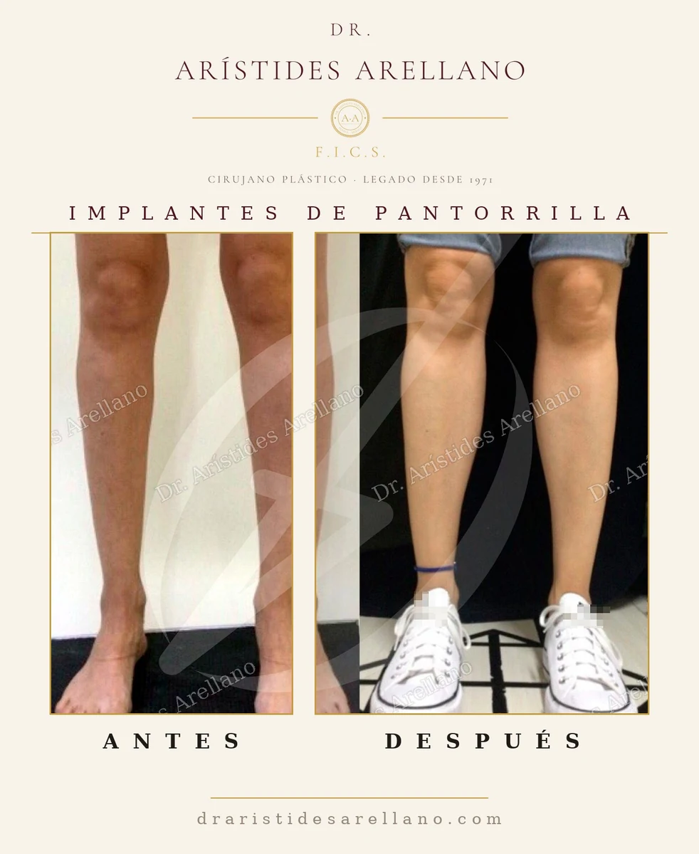 Implantes de pantorrilla: contorno de la pierna antes y después — cirugía del Dr. Arístides Arellano, cirujano plástico en Puebla