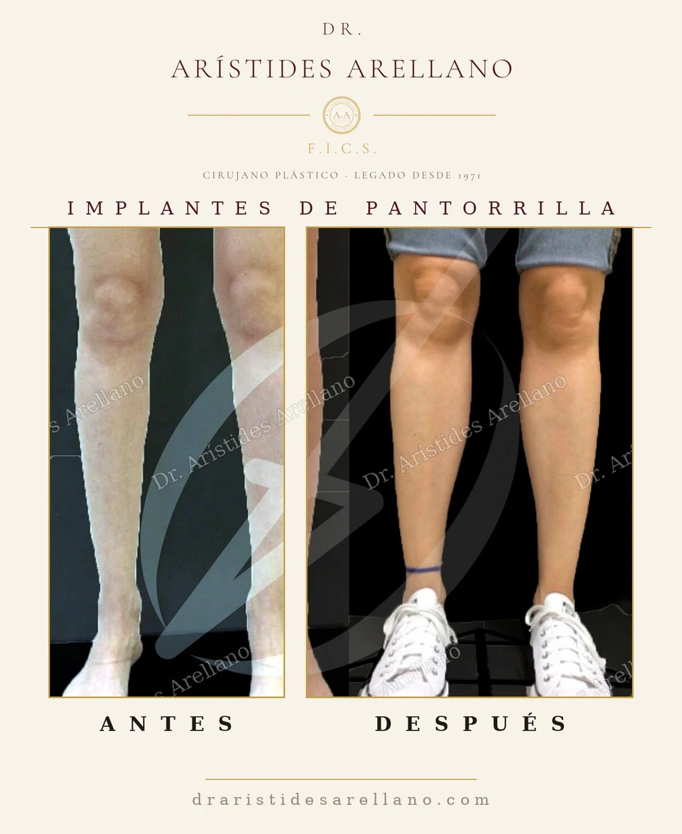 Implantes de pantorrilla, segundo caso: volumen y proporción de la pierna — antes y después con el Dr. Arístides Arellano en Puebla