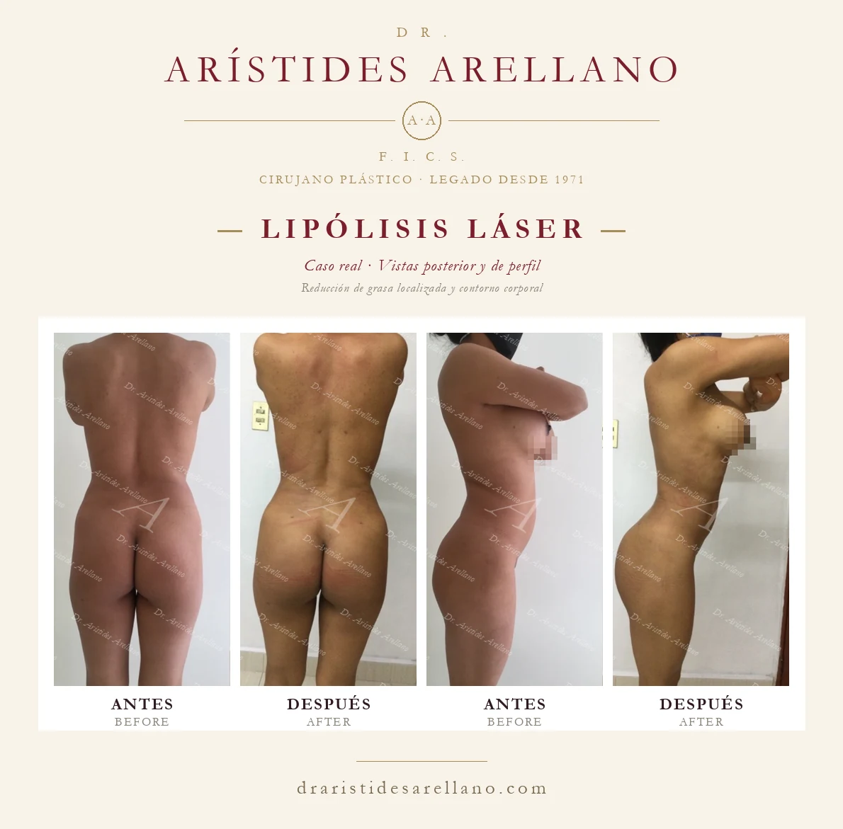 Lipólisis láser — antes y después en vistas posterior y de perfil, reducción de grasa localizada y contorno corporal, caso real del Dr. Arístides Arellano en Puebla