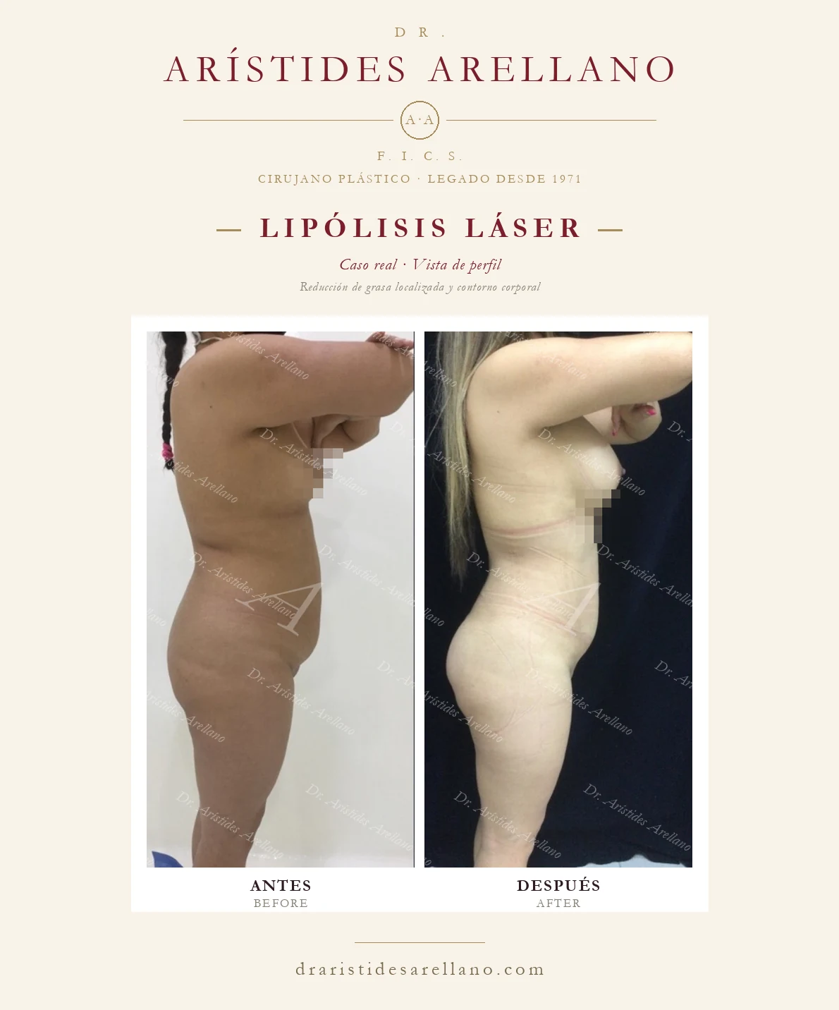 Lipólisis láser — antes y después en vistas de perfil, reducción de grasa localizada y contorno corporal, caso real del Dr. Arístides Arellano en Puebla