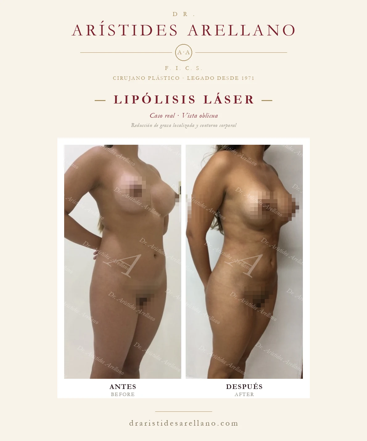 Lipólisis láser — antes y después en vistas oblicua, reducción de grasa localizada y contorno corporal, caso real del Dr. Arístides Arellano en Puebla