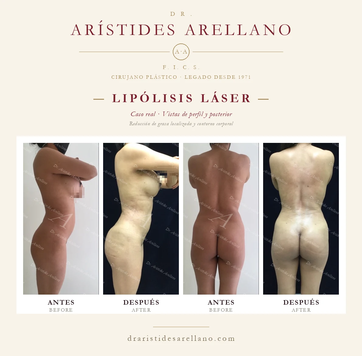 Lipólisis láser — antes y después en vistas de perfil y posterior, reducción de grasa localizada y contorno corporal, caso real del Dr. Arístides Arellano en Puebla