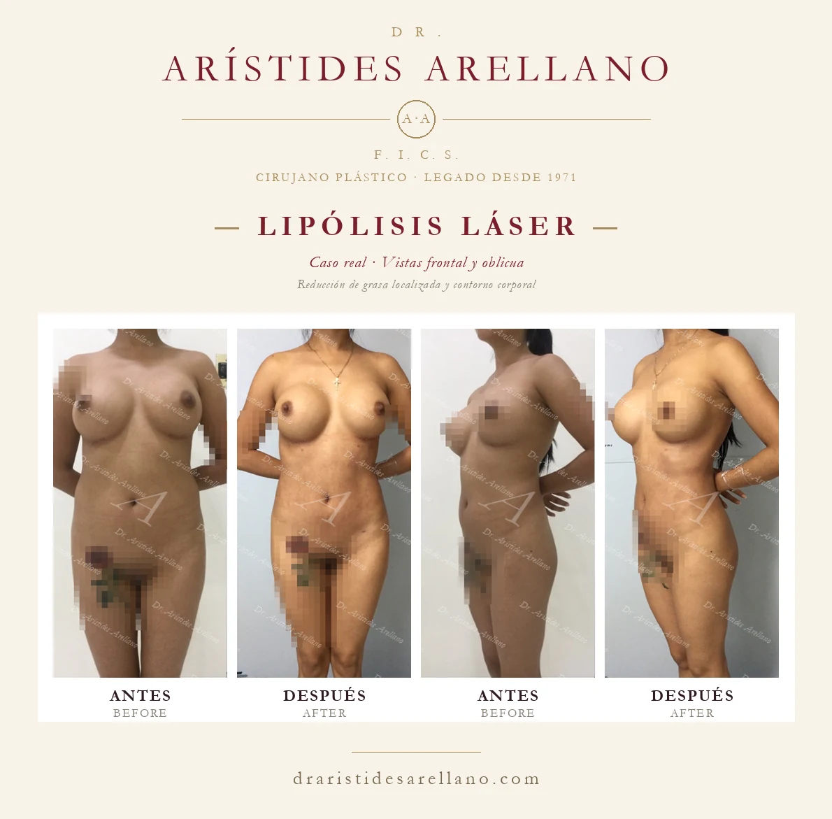 Lipólisis láser — antes y después en vistas frontal y oblicua, reducción de grasa localizada y contorno corporal, caso real del Dr. Arístides Arellano en Puebla