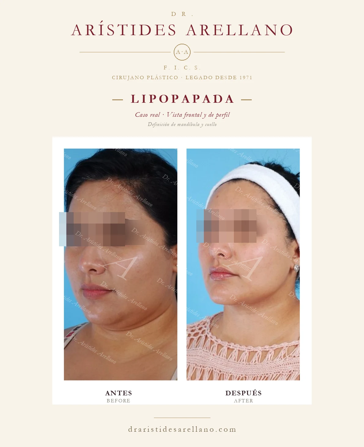 Lipopapada en Puebla — vista frontal y de perfil — definición de mandíbula y cuello, antes y después con el Dr. Arístides Arellano