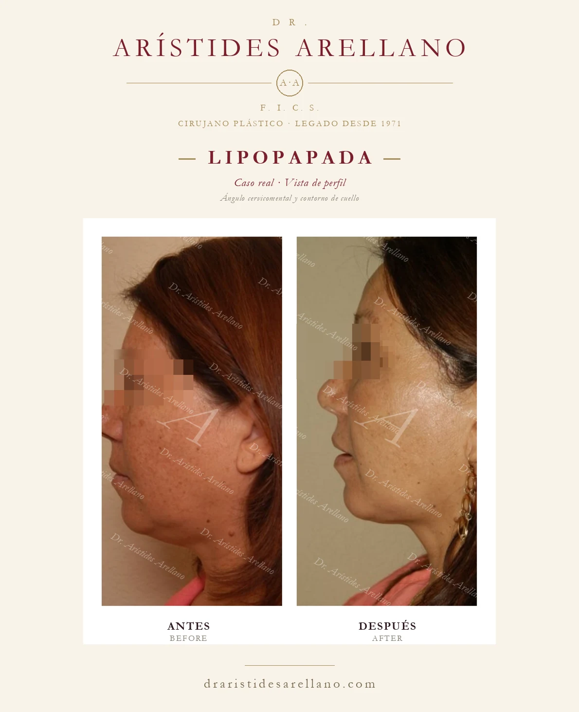 Lipopapada en Puebla — vista de perfil — ángulo cervicomental y contorno de cuello, antes y después con el Dr. Arístides Arellano