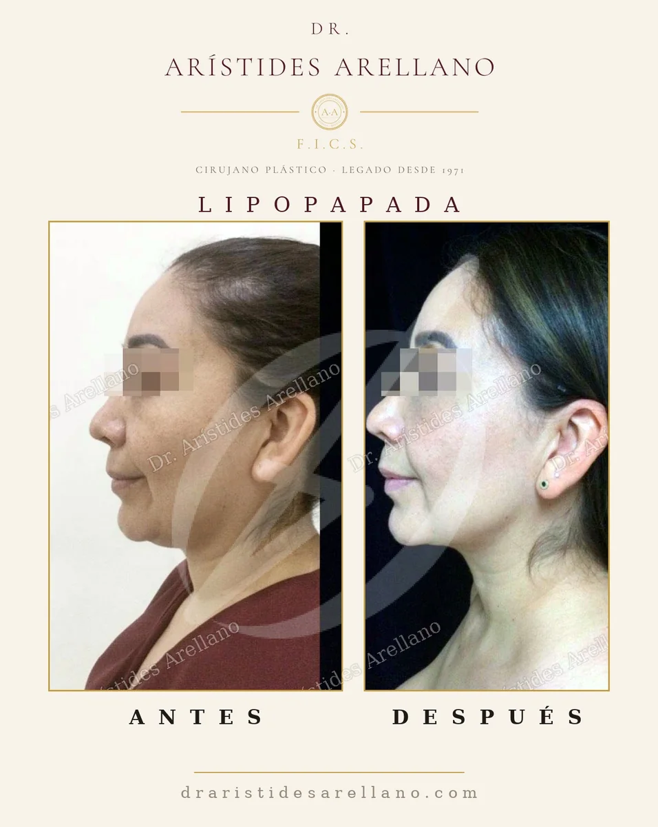 Lipopapada (liposucción de papada) — antes y después, definición del mentón con el Dr. Arístides Arellano en Puebla