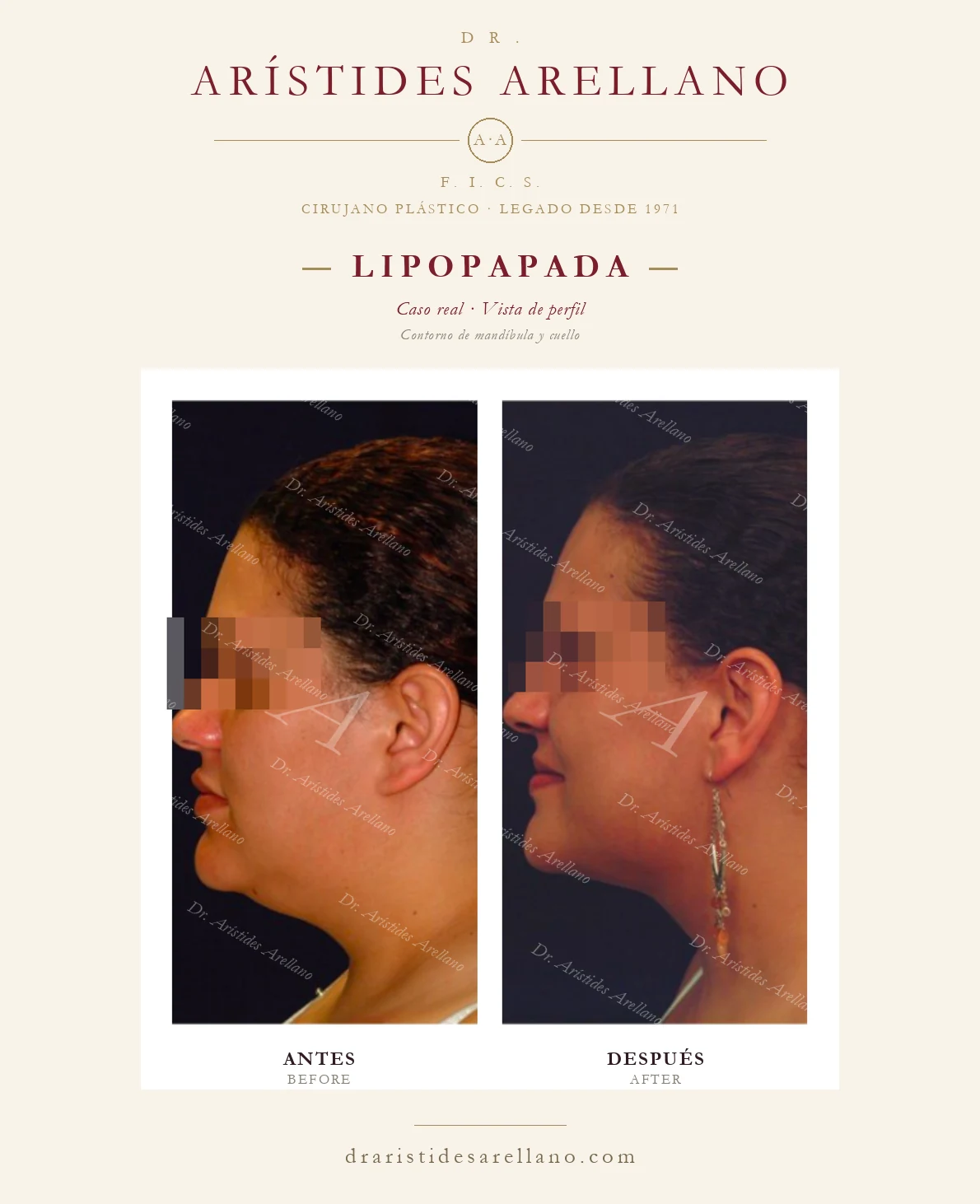 Lipopapada en Puebla — vista de perfil — contorno de mandíbula y cuello, antes y después con el Dr. Arístides Arellano