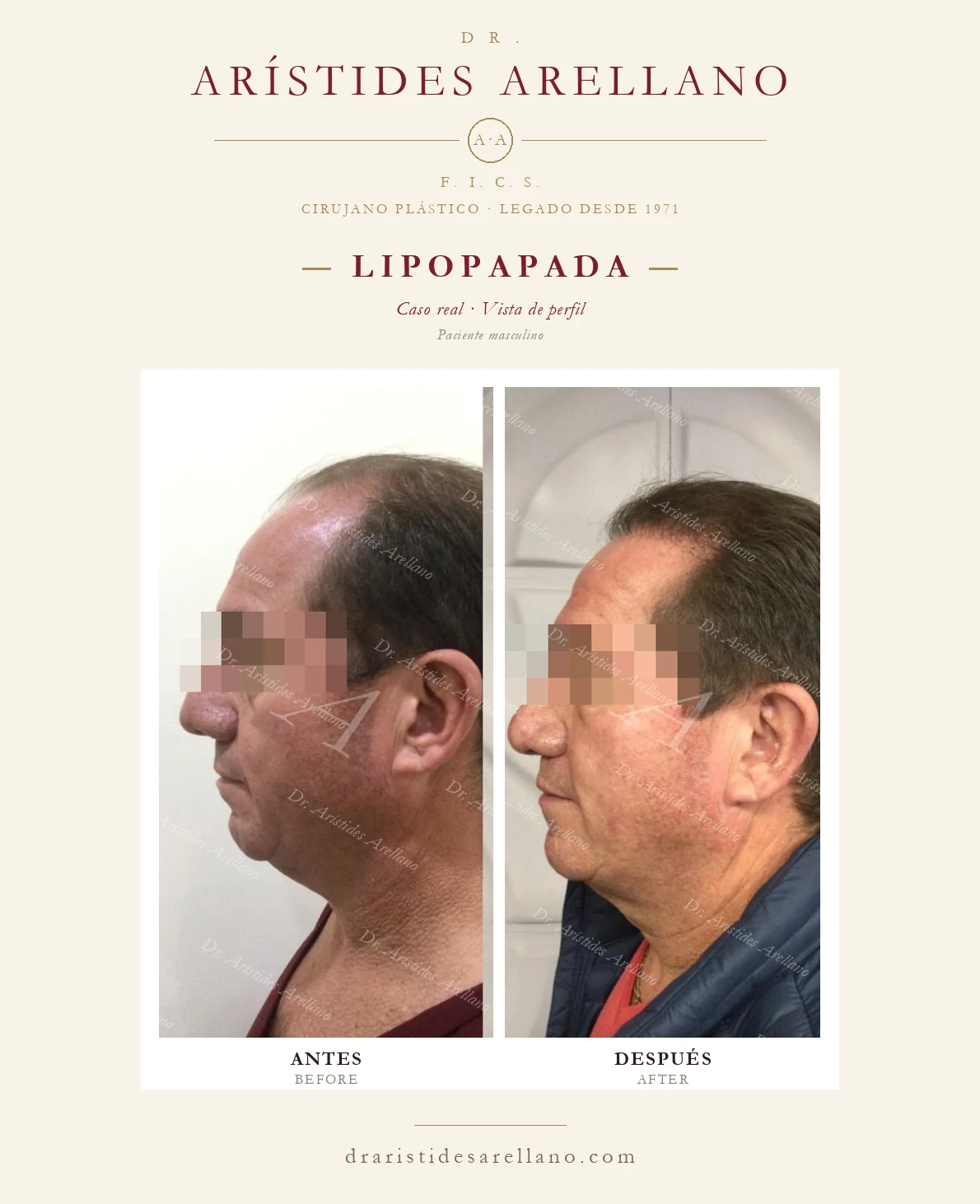 Lipopapada en Puebla — paciente masculino, vista de perfil, antes y después con el Dr. Arístides Arellano