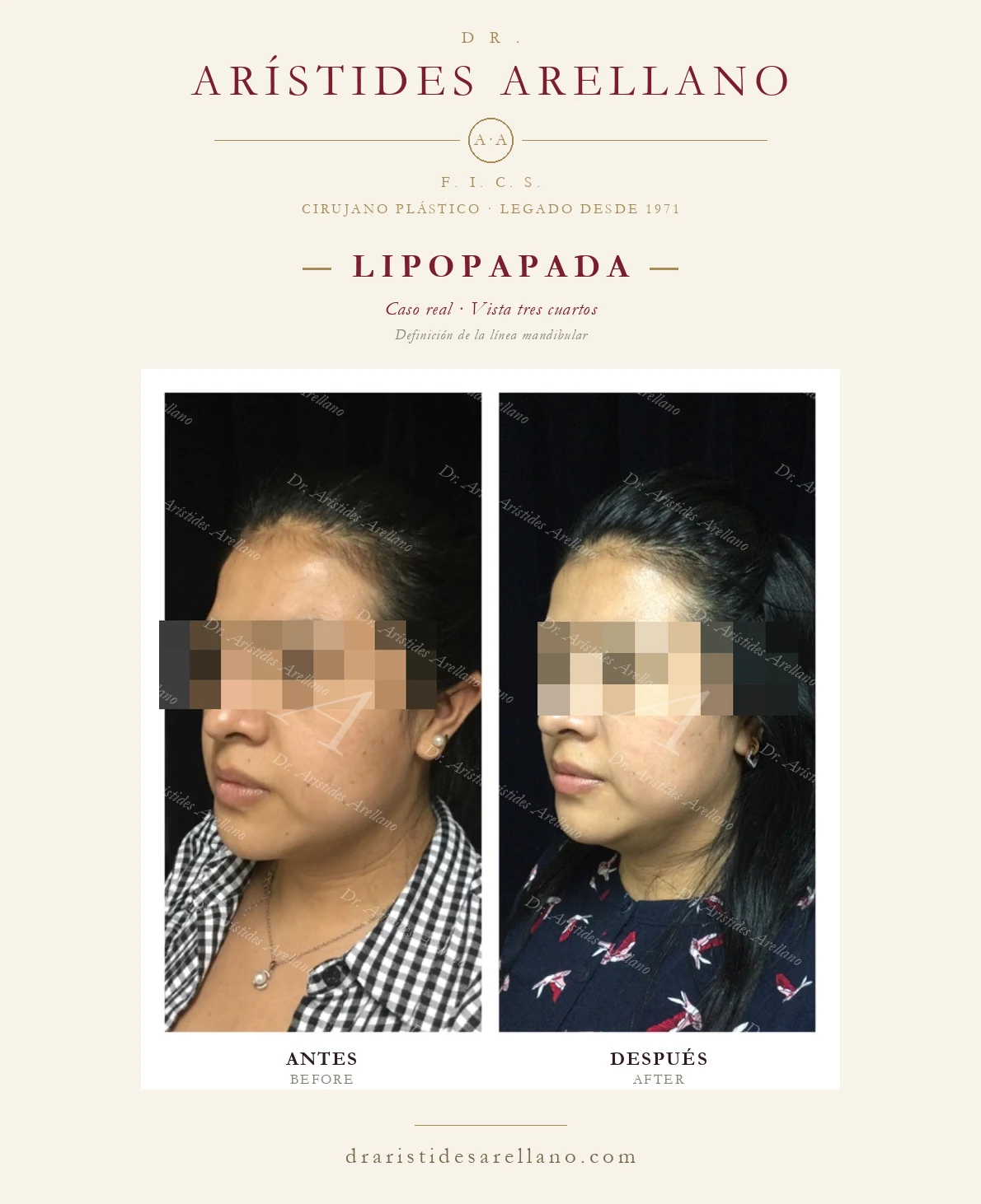 Lipopapada en Puebla — vista tres cuartos — definición de la línea mandibular, antes y después con el Dr. Arístides Arellano