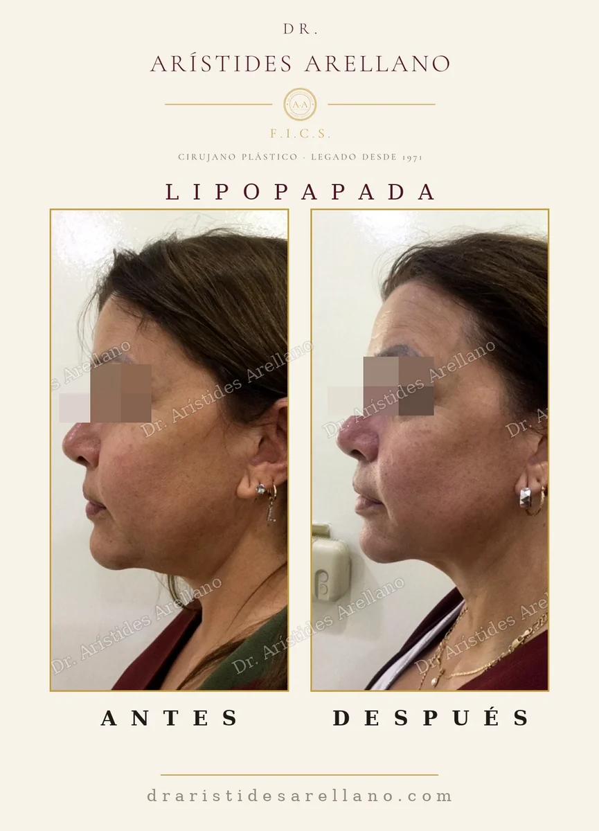 Lipopapada antes y después, eliminación de la papada y definición del ángulo del cuello, cirugía del Dr. Arístides Arellano, cirujano plástico en Puebla