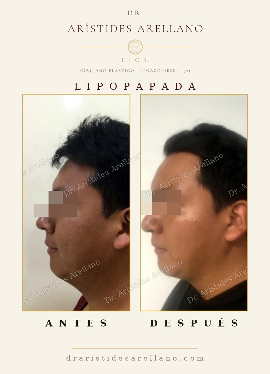 Lipopapada antes y después en vista de perfil, papada en persona delgada, resultado real del Dr. Arístides Arellano en Puebla