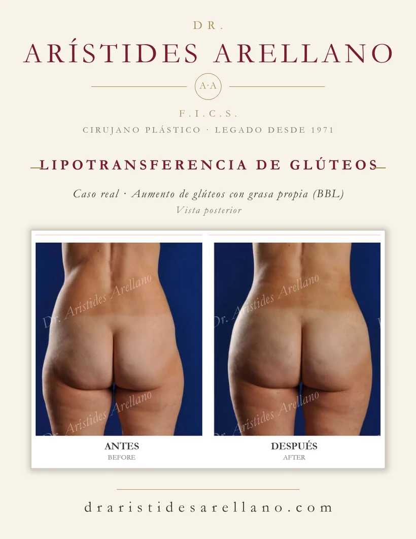 Lipotransferencia de glúteos (aumento de glúteos con grasa propia, BBL) — antes y después, vista posterior, caso real del Dr. Arístides Arellano en Puebla