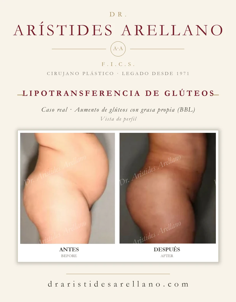 Lipotransferencia de glúteos (aumento de glúteos con grasa propia, BBL) — antes y después, vista de perfil, caso real del Dr. Arístides Arellano en Puebla