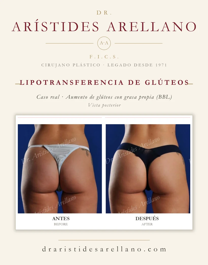 Lipotransferencia de glúteos (aumento de glúteos con grasa propia, BBL) — antes y después, vista posterior, caso real del Dr. Arístides Arellano en Puebla