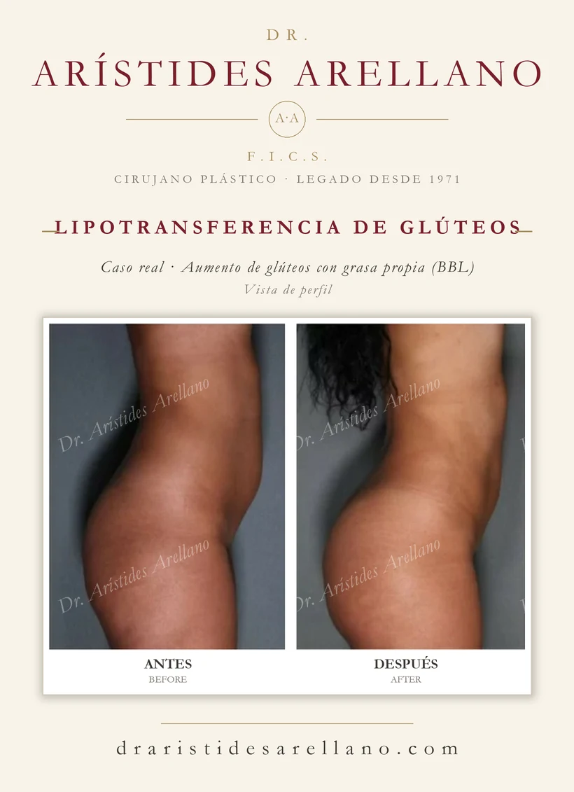 Lipotransferencia de glúteos (aumento de glúteos con grasa propia, BBL) — antes y después, vista de perfil, caso real del Dr. Arístides Arellano en Puebla