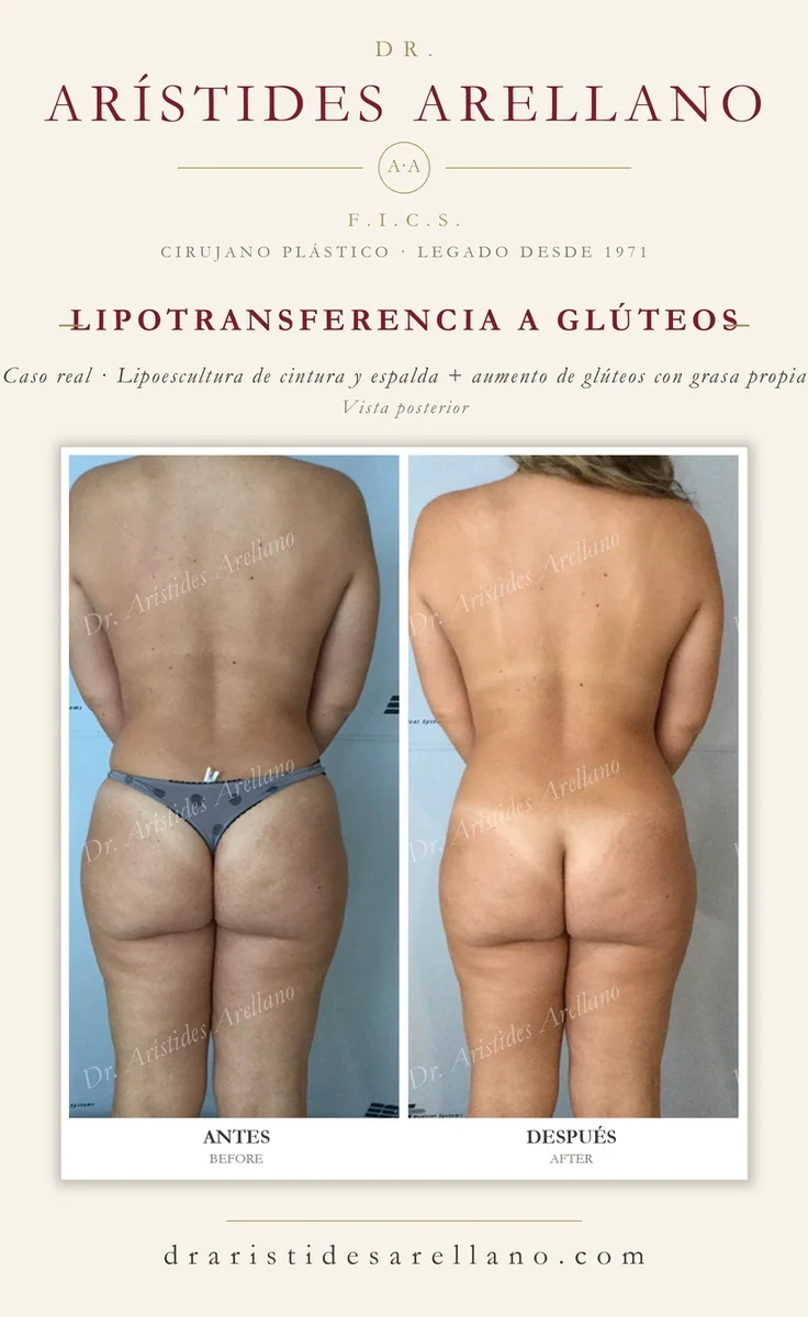 Lipotransferencia a glúteos con lipoescultura de cintura y espalda — antes y después vista posterior, caso real del Dr. Arístides Arellano en Puebla