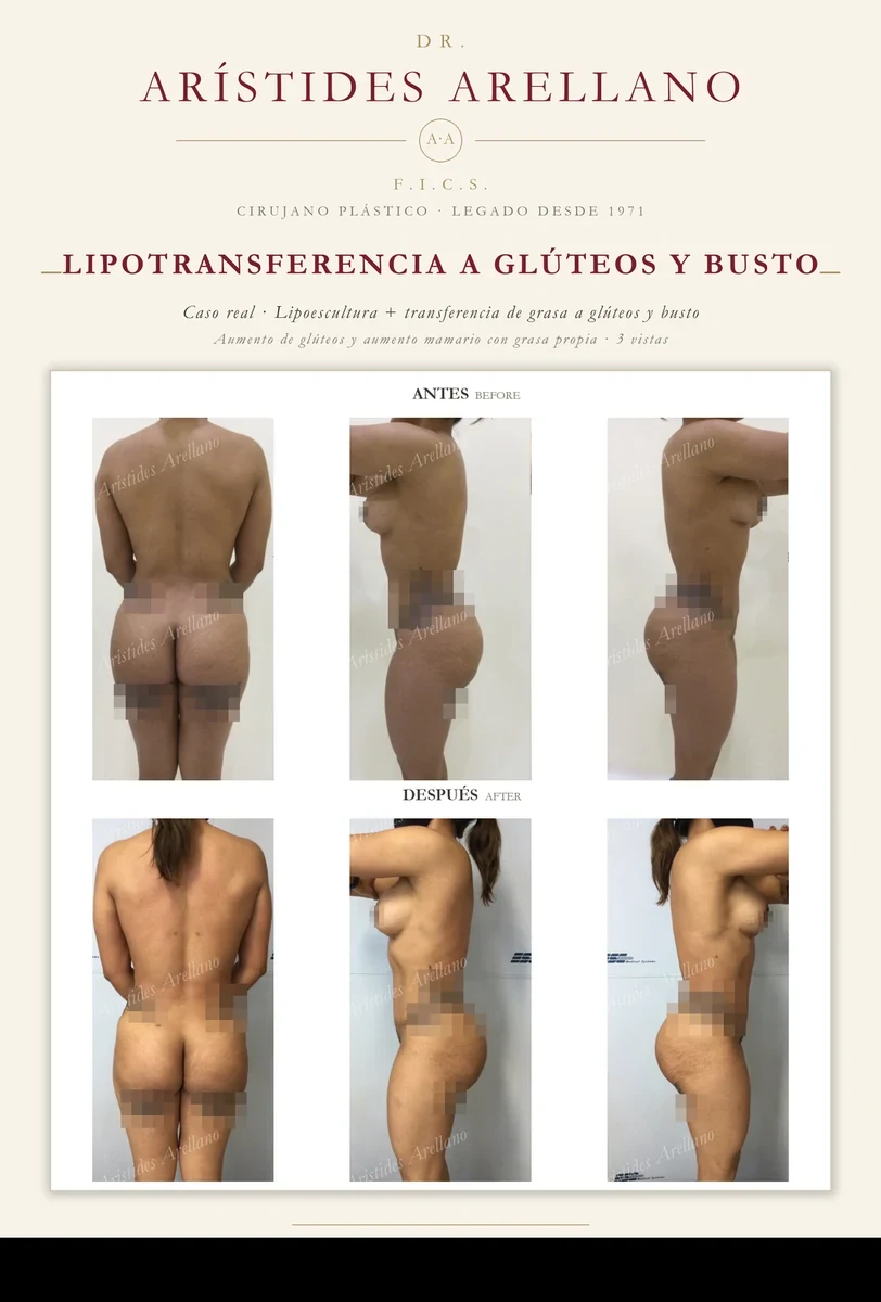 Lipotransferencia a glúteos y busto — antes y después en 3 vistas: aumento de glúteos y aumento de busto con grasa propia, caso real del Dr. Arístides Arellano en Puebla