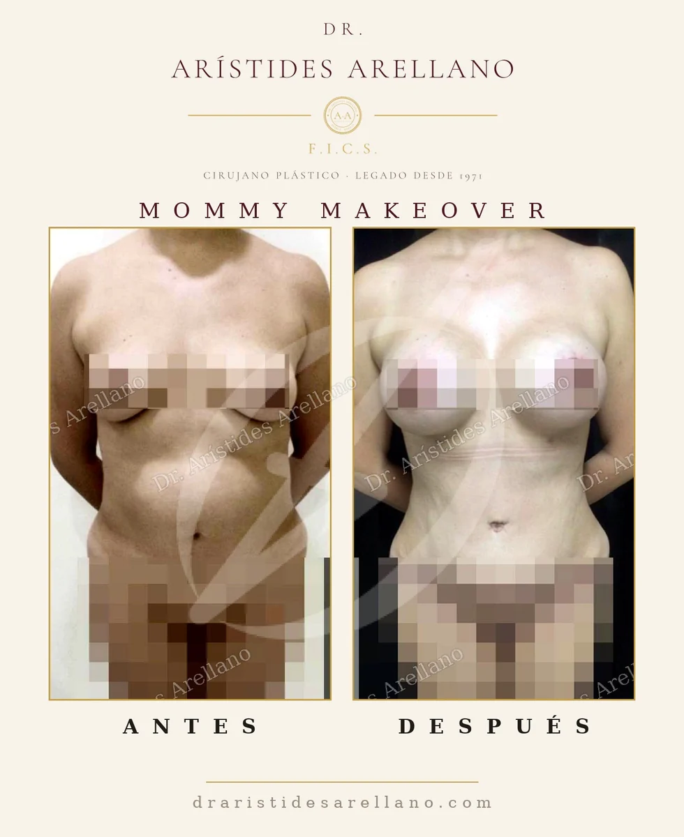 Mommy makeover antes y después de frente, abdomen y busto tratados juntos, cirugía del Dr. Arístides Arellano, cirujano plástico en Puebla